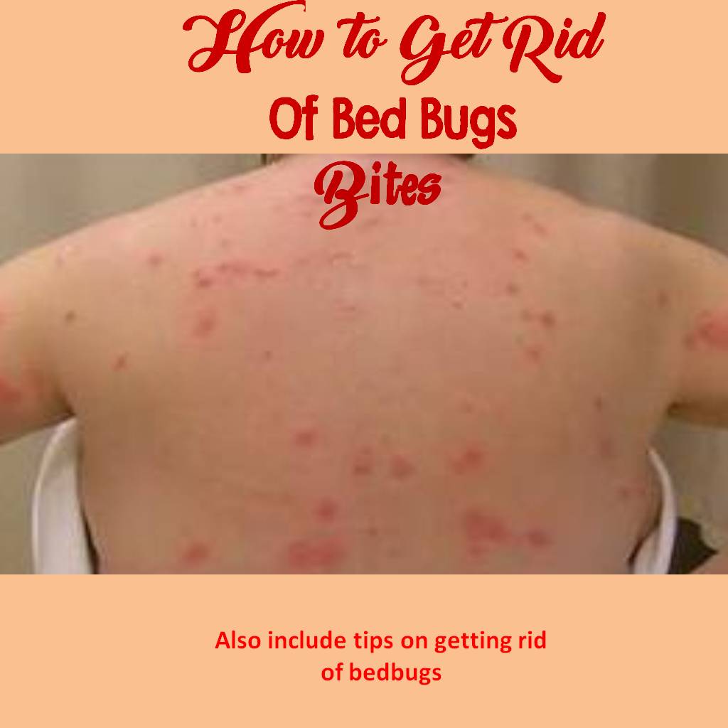 How to Get Rid Of Bed Bug Bites  Online Pest Control