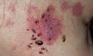 bedbug bites