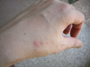 signs of bedbug bites