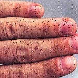 Bird mites on a human hand 