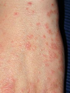 Chigger bites