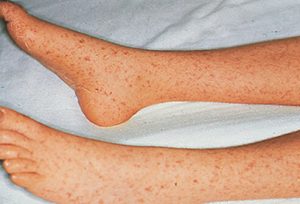 Early symptoms of Rocky Mountain Spotted Fever.