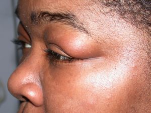 Swelling near the eyelids - sign of Chagas