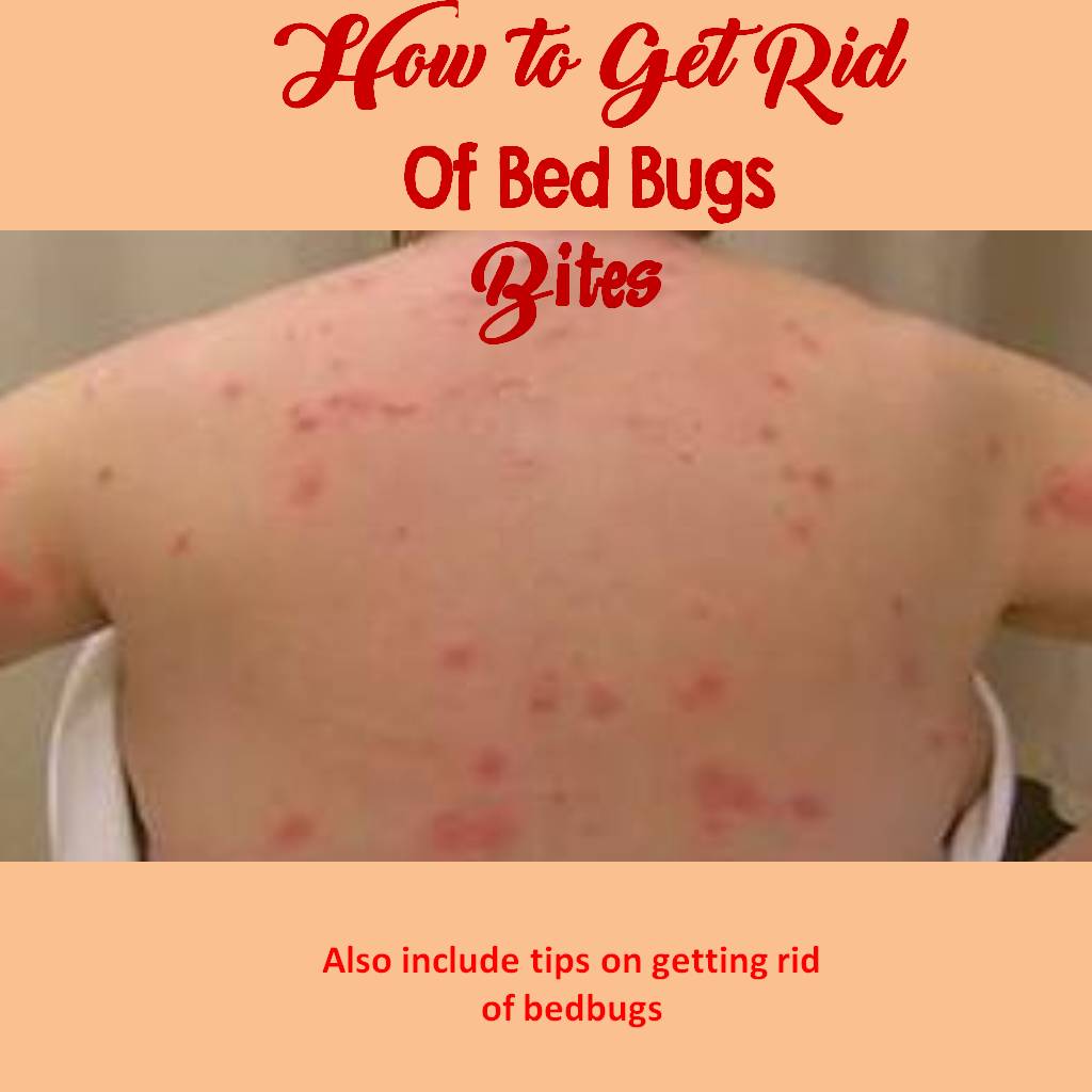 How To Get Rid Of Bed Bug Bites Online Pest Control